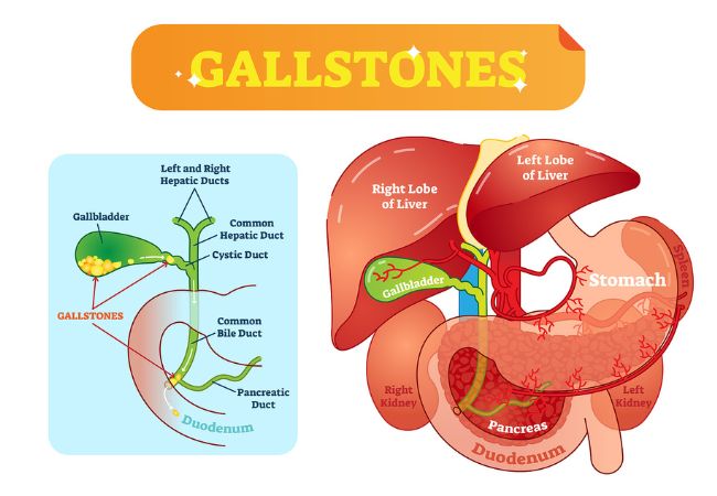 Gallstones illustration