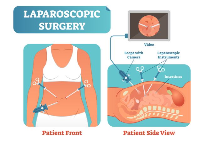 Laparoscopic surgery illustrations