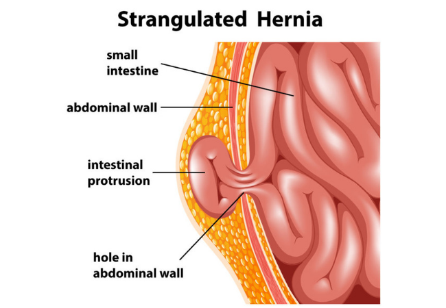 Hernia illustration