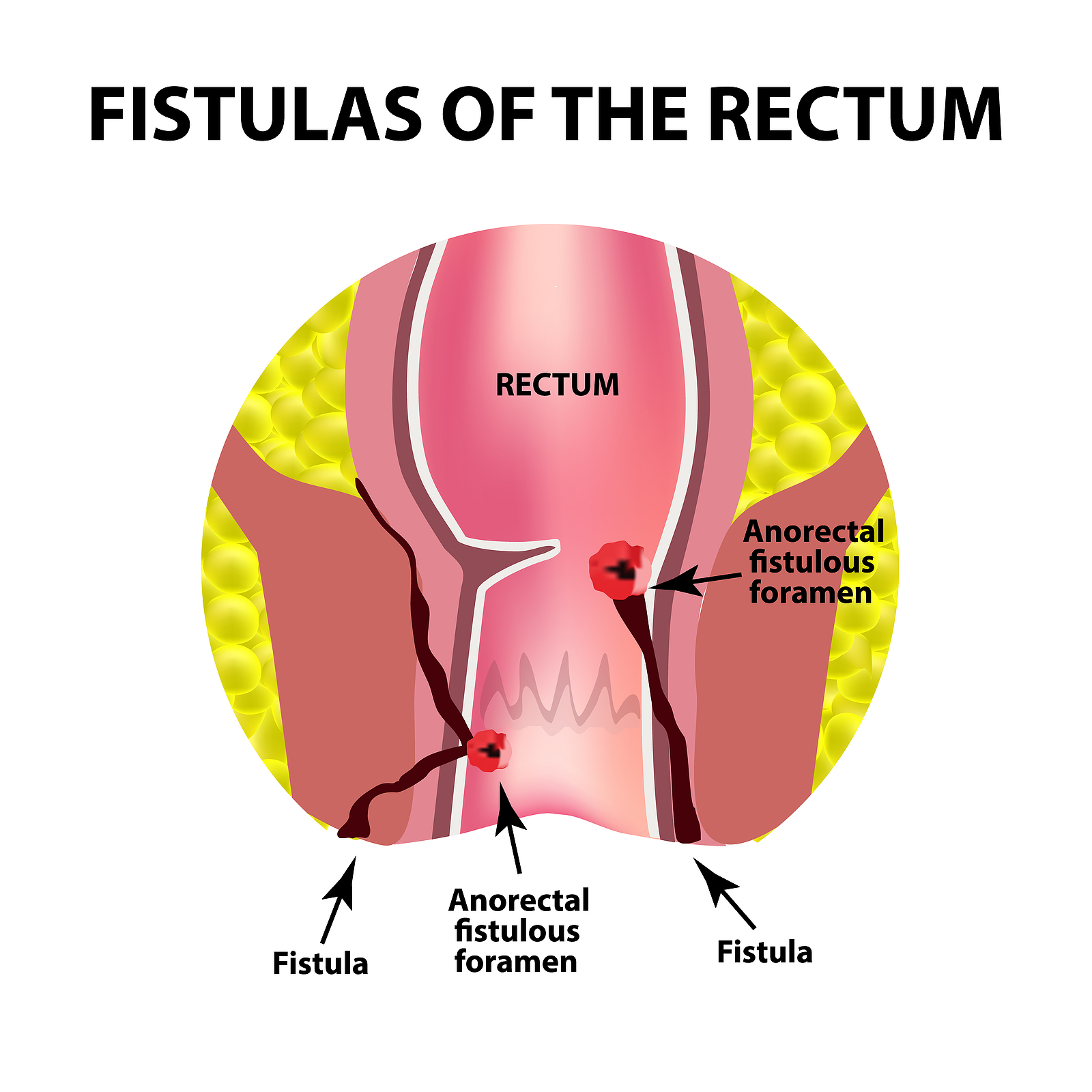 Anal Fistula Illustration