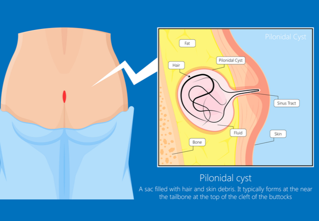 Pilonidal Sinus illustration